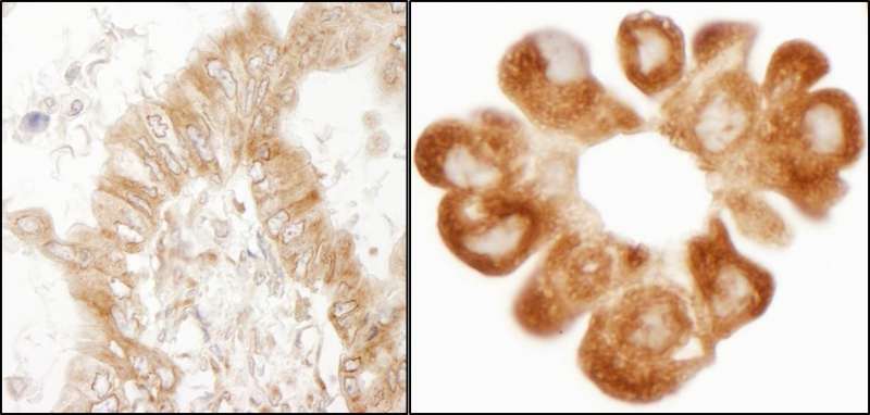 RPL7 / Ribosomal Protein L7 Antibody - Detection of Human RPL7 by Immunohistochemistry. Sample: FFPE section of human lung carcinoma and bronchioalveolar carcinoma pleural effusion. Antibody: Affinity purified rabbit anti-RPL7 used at a dilution of 1:1000 (0.2 ug/ml) and 1:200 (1 ug/ml). Detection: DAB.