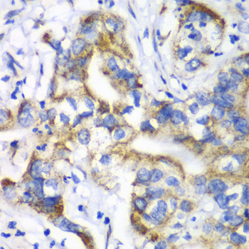 RPL9 / Ribosomal Protein L9 Antibody - Immunohistochemistry of paraffin-embedded human liver cancer tissue.