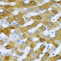 RPL9 / Ribosomal Protein L9 Antibody - Immunohistochemical analysis of RPL9 staining in human liver cancer formalin fixed paraffin embedded tissue section. The section was pre-treated using heat mediated antigen retrieval with sodium citrate buffer (pH 6.0). The section was then incubated with the antibody at room temperature and detected using an HRP conjugated compact polymer system. DAB was used as the chromogen. The section was then counterstained with hematoxylin and mounted with DPX.