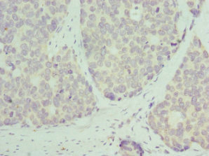 RPL9 / Ribosomal Protein L9 Antibody - Immunohistochemistry of paraffin-embedded human gastric cancer at dilution 1:100