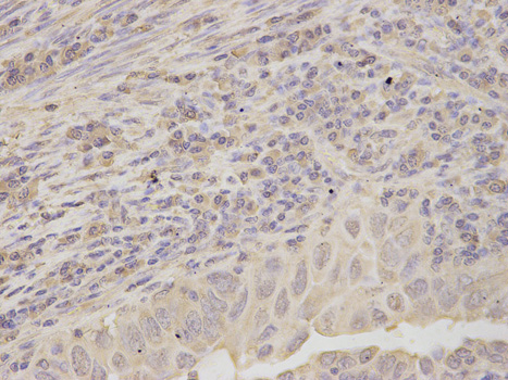 RPLP0 Antibody - Immunohistochemistry of paraffin-embedded human endometrial cancer using RPLP0 antibody at dilution of 1:200 (400x lens).
