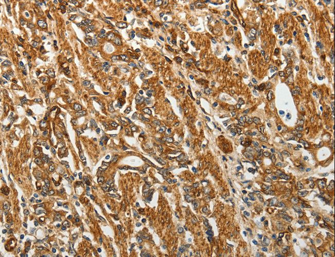 RPLP0 Antibody - Immunohistochemistry of paraffin-embedded Human gastric cancer using RPLP0 Polyclonal Antibody at dilution of 1:40.