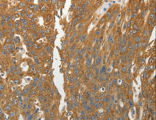 RPLP0 Antibody - Immunohistochemistry of paraffin-embedded Human ovarian cancer using RPLP0 Polyclonal Antibody at dilution of 1:40.
