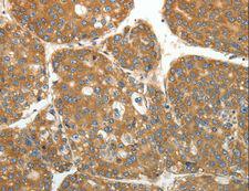 RPLP0 Antibody - Immunohistochemistry of paraffin-embedded Human liver cancer using RPLP0 Polyclonal Antibody at dilution of 1:40.