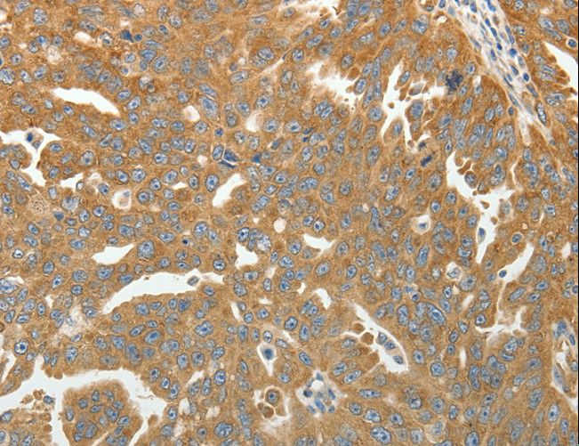 RPLP0 Antibody - Immunohistochemistry of paraffin-embedded Human ovarian cancer using RPLP0 Polyclonal Antibody at dilution of 1:40.