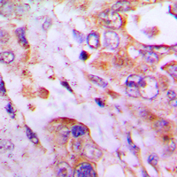 RPLP2 Antibody - Immunohistochemical analysis of RPLP2 staining in human lung cancer formalin fixed paraffin embedded tissue section. The section was pre-treated using heat mediated antigen retrieval with sodium citrate buffer (pH 6.0). The section was then incubated with the antibody at room temperature and detected using an HRP-conjugated compact polymer system. DAB was used as the chromogen. The section was then counterstained with hematoxylin and mounted with DPX.