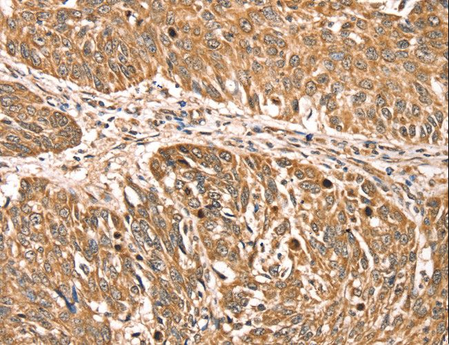 RPLP2 Antibody - Immunohistochemistry of paraffin-embedded Human lung cancer using RPLP2 Polyclonal Antibody at dilution of 1:35.