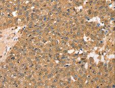 RPLP2 Antibody - Immunohistochemistry of paraffin-embedded Human breast cancer using RPLP2 Polyclonal Antibody at dilution of 1:40.