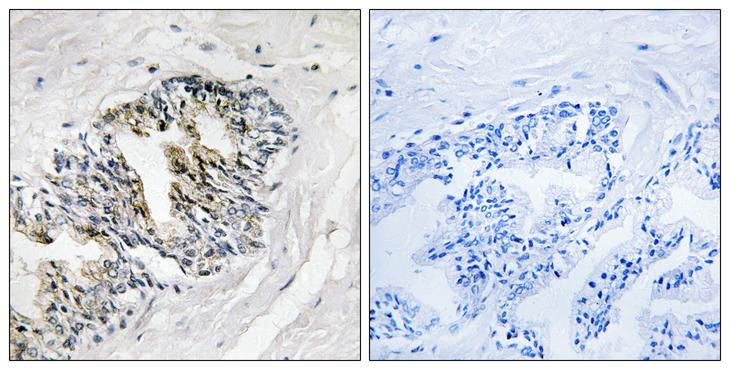 RPLP2 Antibody - Peptide - + Immunohistochemistry analysis of paraffin-embedded human prostate carcinoma tissue using RPLP2 antibody.