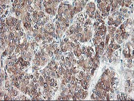 RPN1 / Ribophorin I Antibody - IHC of paraffin-embedded Carcinoma of Human liver tissue using anti-RPN1 mouse monoclonal antibody.