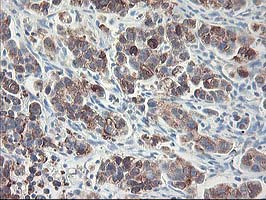 RPN1 / Ribophorin I Antibody - IHC of paraffin-embedded Carcinoma of Human lung tissue using anti-RPN1 mouse monoclonal antibody.