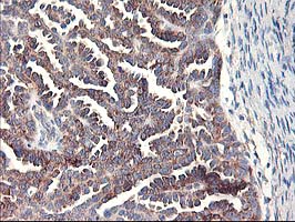 RPN1 / Ribophorin I Antibody - IHC of paraffin-embedded Adenocarcinoma of Human ovary tissue using anti-RPN1 mouse monoclonal antibody.