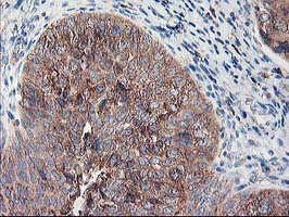 RPN1 / Ribophorin I Antibody - IHC of paraffin-embedded Carcinoma of Human bladder tissue using anti-RPN1 mouse monoclonal antibody.