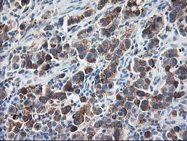 RPN1 / Ribophorin I Antibody - IHC of paraffin-embedded Carcinoma of Human lung tissue using anti-RPN1 mouse monoclonal antibody.
