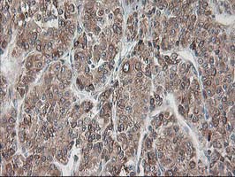 RPN1 / Ribophorin I Antibody - IHC of paraffin-embedded Carcinoma of Human liver tissue using anti-RPN1 mouse monoclonal antibody.