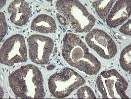 RPN1 / Ribophorin I Antibody - IHC of paraffin-embedded Carcinoma of Human prostate tissue using anti-RPN1 mouse monoclonal antibody.