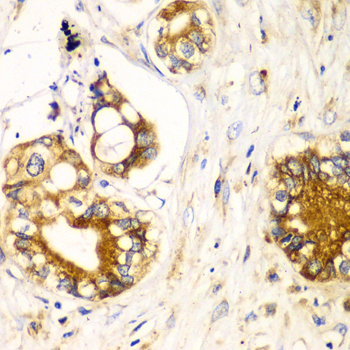 RPN1 / Ribophorin I Antibody - Immunohistochemistry of paraffin-embedded human liver cancer tissue.