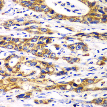RPN1 / Ribophorin I Antibody - Immunohistochemistry of paraffin-embedded human gastric cancer tissue.