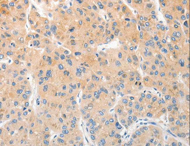 RPN1 / Ribophorin I Antibody - Immunohistochemistry of paraffin-embedded Human liver cancer using RPN1 Polyclonal Antibody at dilution of 1:30.
