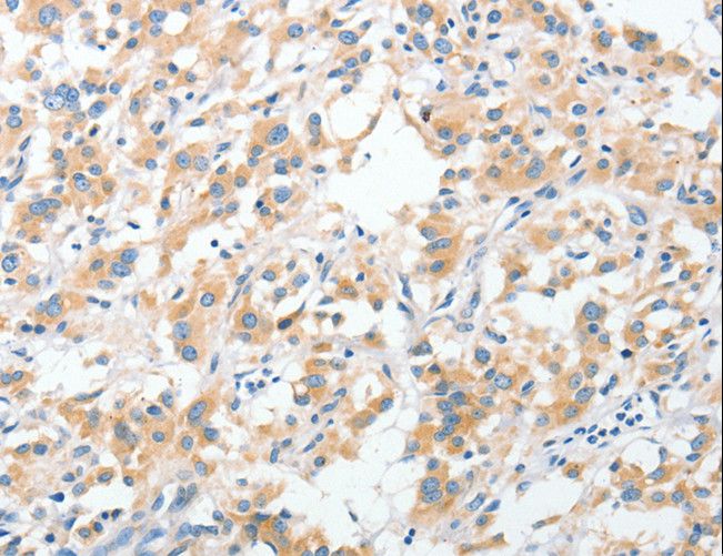 RPN1 / Ribophorin I Antibody - Immunohistochemistry of paraffin-embedded Human thyroid cancer using RPN1 Polyclonal Antibody at dilution of 1:30.