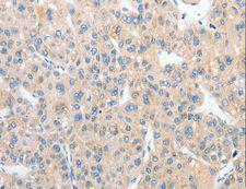 RPN1 / Ribophorin I Antibody - Immunohistochemistry of paraffin-embedded Human liver cancer using RPN1 Polyclonal Antibody at dilution of 1:25.