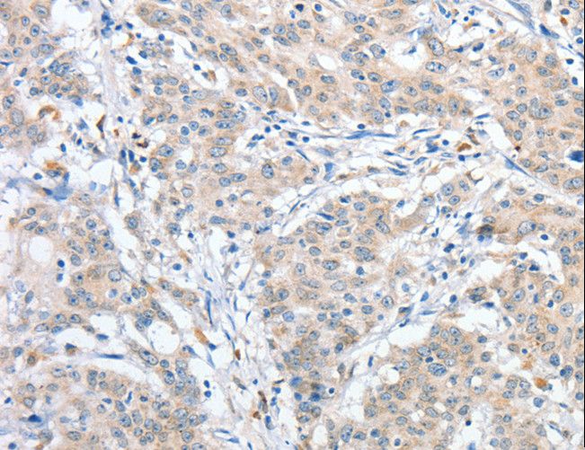 RPN1 / Ribophorin I Antibody - Immunohistochemistry of paraffin-embedded Human gastric cancer using RPN1 Polyclonal Antibody at dilution of 1:25.