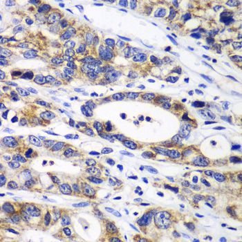 RPN1 / Ribophorin I Antibody - Immunohistochemistry of paraffin-embedded human gastric cancer using RPN1 antibody at dilution of 1:100 (40x lens).