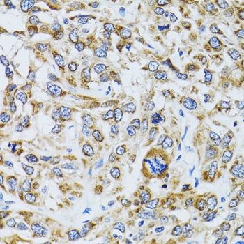 RPN1 / Ribophorin I Antibody - Immunohistochemistry of paraffin-embedded human liver cancer using RPN1 antibody at dilution of 1:100 (40x lens).