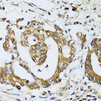 RPN1 / Ribophorin I Antibody - Immunohistochemistry of paraffin-embedded human colon carcinoma using RPN1 antibody at dilution of 1:100 (40x lens).