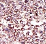 RPN2 / Ribophorin II Antibody - Formalin-fixed and paraffin-embedded human cancer tissue reacted with the primary antibody, which was peroxidase-conjugated to the secondary antibody, followed by DAB staining. This data demonstrates the use of this antibody for immunohistochemistry; clinical relevance has not been evaluated. BC = breast carcinoma; HC = hepatocarcinoma.
