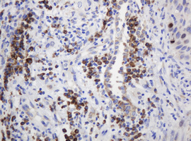 RPN2 / Ribophorin II Antibody - IHC of paraffin-embedded Carcinoma of Human lung tissue using anti-RPN2 mouse monoclonal antibody.