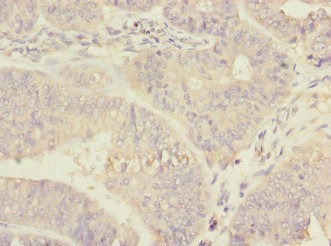 RPN2 / Ribophorin II Antibody - Immunohistochemistry of paraffin-embedded human endometrial cancer at dilution 1:100