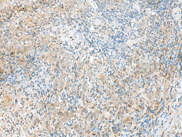 RPP14 Antibody - Immunohistochemistry of paraffin-embedded Human cervical cancer tissue  using RPP14 Polyclonal Antibody at dilution of 1:60(×200)