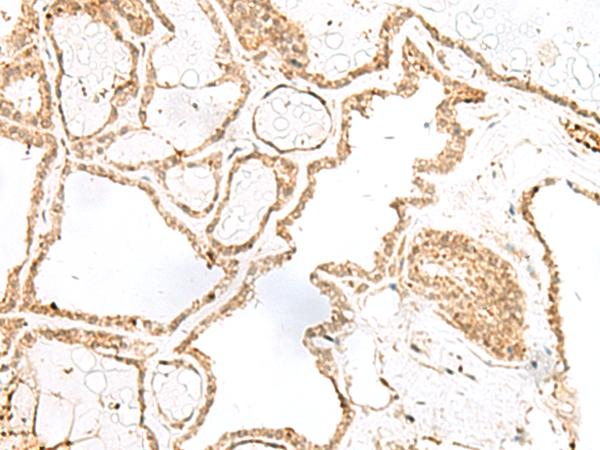 RPP14 Antibody - Immunohistochemistry of paraffin-embedded Human thyroid cancer tissue  using RPP14 Polyclonal Antibody at dilution of 1:60(×200)