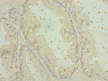 RPP25L / C9orf23 Antibody - Immunohistochemistry of paraffin-embedded human prostate cancer at dilution of 1:100