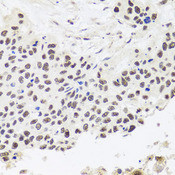 RPP30 Antibody - Immunohistochemistry of paraffin-embedded human lung cancer tissue.