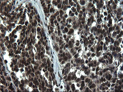 RPRD1B Antibody - IHC of paraffin-embedded Adenocarcinoma of Human colon tissue using anti-RPRD1B mouse monoclonal antibody. (Heat-induced epitope retrieval by 1 mM EDTA in 10mM Tris, pH8.5, 120°C for 3min).