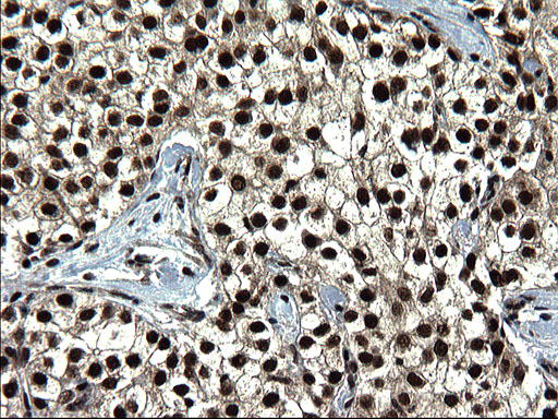 RPRD1B Antibody - IHC of paraffin-embedded Carcinoma of Human liver tissue using anti-RPRD1B mouse monoclonal antibody. (Heat-induced epitope retrieval by 1 mM EDTA in 10mM Tris, pH8.5, 120°C for 3min).