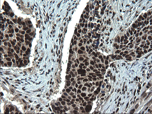 RPRD1B Antibody - IHC of paraffin-embedded Carcinoma of Human lung tissue using anti-RPRD1B mouse monoclonal antibody. (Heat-induced epitope retrieval by 1 mM EDTA in 10mM Tris, pH8.5, 120°C for 3min).