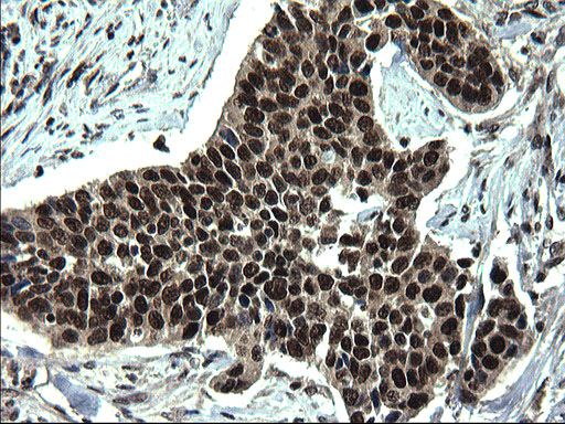 RPRD1B Antibody - IHC of paraffin-embedded Carcinoma of Human bladder tissue using anti-RPRD1B mouse monoclonal antibody. (Heat-induced epitope retrieval by 1 mM EDTA in 10mM Tris, pH8.5, 120°C for 3min).