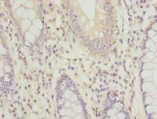 RPRD1B Antibody - Immunohistochemistry of paraffin-embedded human colon cancer using antibody at dilution of 1:100.
