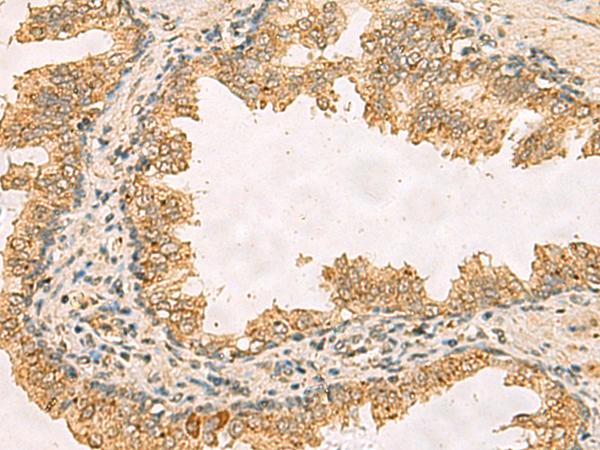 RPS11 / Ribosomal Protein 11 Antibody - Immunohistochemistry of paraffin-embedded Human prost ate cancer tissue  using RPS11 Polyclonal Antibody at dilution of 1:40(×200)