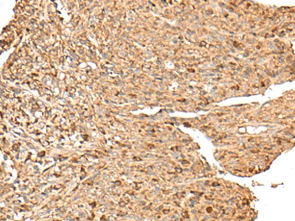 RPS12 / Ribosomal Protein S12 Antibody - Immunohistochemistry of paraffin-embedded Human liver cancer tissue  using RPS12 Polyclonal Antibody at dilution of 1:70(×200)
