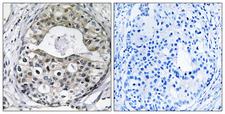 RPS13 / Ribosomal Protein S13 Antibody - Peptide - + Immunohistochemistry analysis of paraffin-embedded human breast carcinoma tissue using RPS13 antibody.