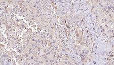 RPS14 / Ribosomal Protein S14 Antibody - 1:100 staining human thyroid carcinoma tissue by IHC-P. The sample was formaldehyde fixed and a heat mediated antigen retrieval step in citrate buffer was performed. The sample was then blocked and incubated with the antibody for 1.5 hours at 22°C. An HRP conjugated goat anti-rabbit antibody was used as the secondary.