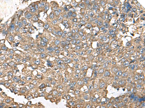 RPS14 / Ribosomal Protein S14 Antibody - Immunohistochemistry of paraffin-embedded Human liver cancer tissue  using RPS14 Polyclonal Antibody at dilution of 1:50(×200)