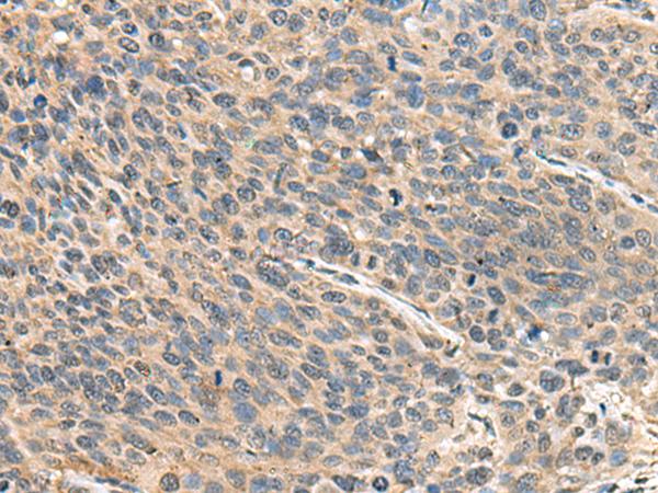 RPS14 / Ribosomal Protein S14 Antibody - Immunohistochemistry of paraffin-embedded Human cervical cancer tissue  using RPS14 Polyclonal Antibody at dilution of 1:50(×200)