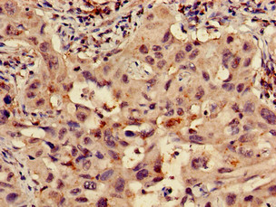 RPS15 / Ribosomal Protein S15 Antibody - Immunohistochemistry of paraffin-embedded human lung cancer using RPS15 Antibody at dilution of 1:100