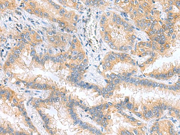 RPS16 / Ribosomal Protein S16 Antibody - Immunohistochemistry of paraffin-embedded Human lung cancer tissue  using RPS16 Polyclonal Antibody at dilution of 1:60(×200)