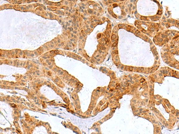 RPS16 / Ribosomal Protein S16 Antibody - Immunohistochemistry of paraffin-embedded Human thyroid cancer tissue  using RPS16 Polyclonal Antibody at dilution of 1:60(×200)